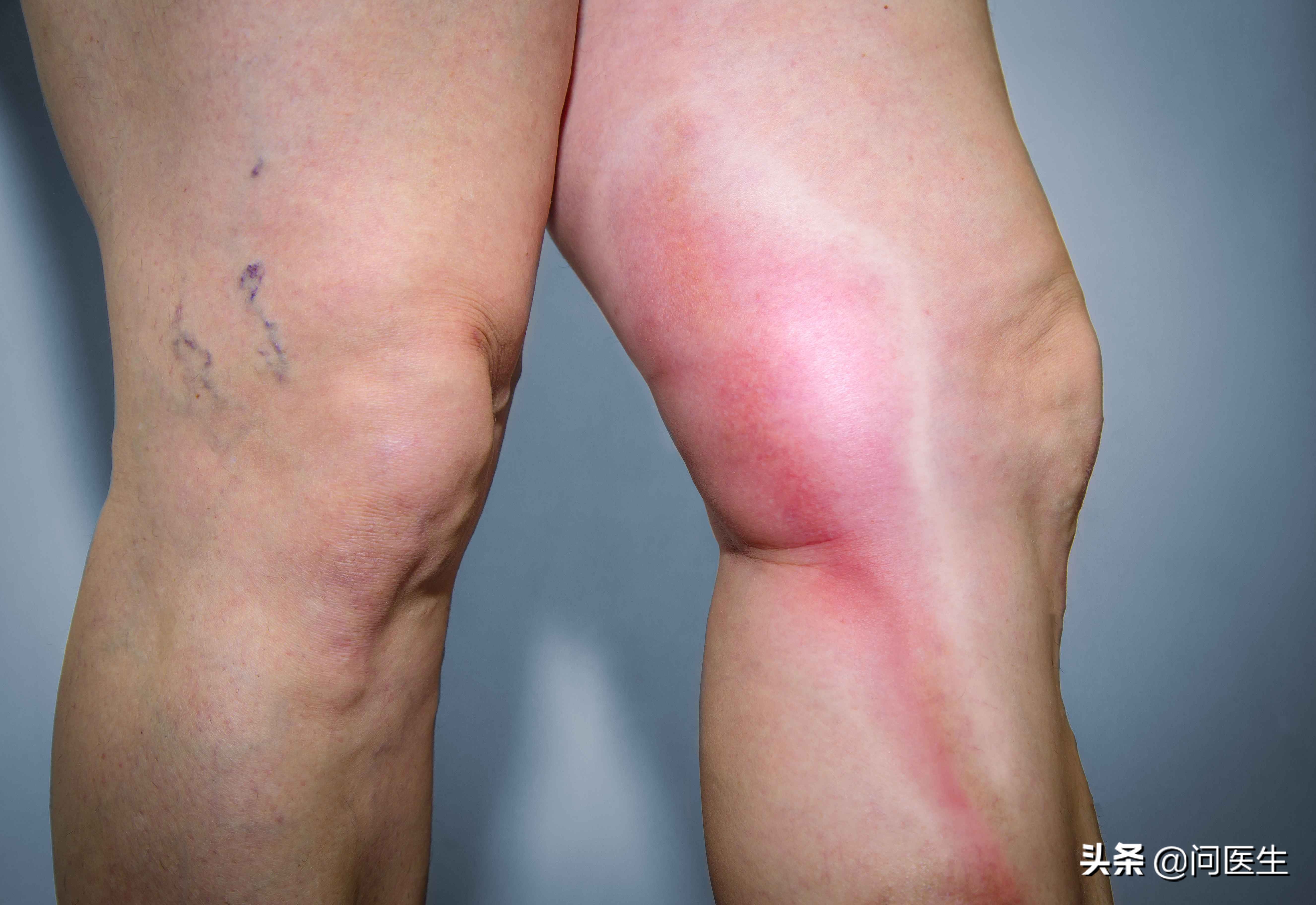 尿酸高脚部有什么反应,尿酸高下肢水肿