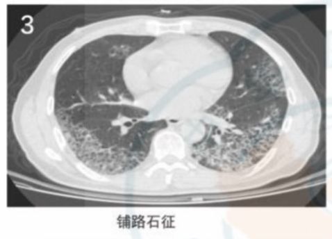 磨玻璃阴影怎么处理,磨玻璃阴影