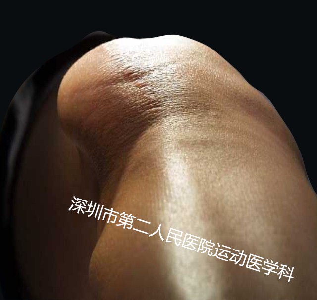 髌骨半脱位关节镜微创手术,髌骨脱位二联手术