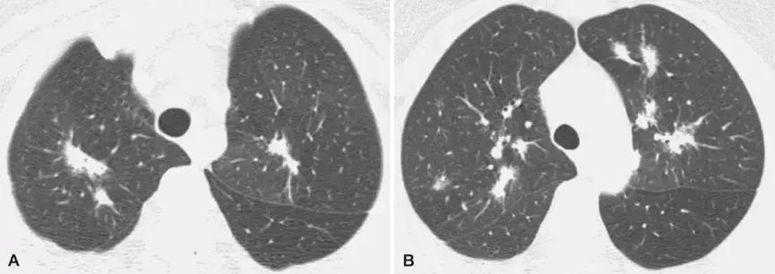 机化性肺炎平时应关注什么,机化性肺炎的正规治疗