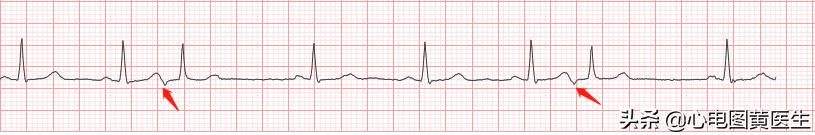 频发室性早搏部分为室性融合波,室性早搏与差异性传导鉴别