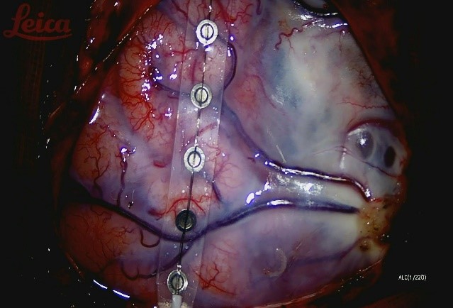 三叉神经痛需要抗癫痫治疗吗,癫痫引起的三叉神经痛怎么治疗