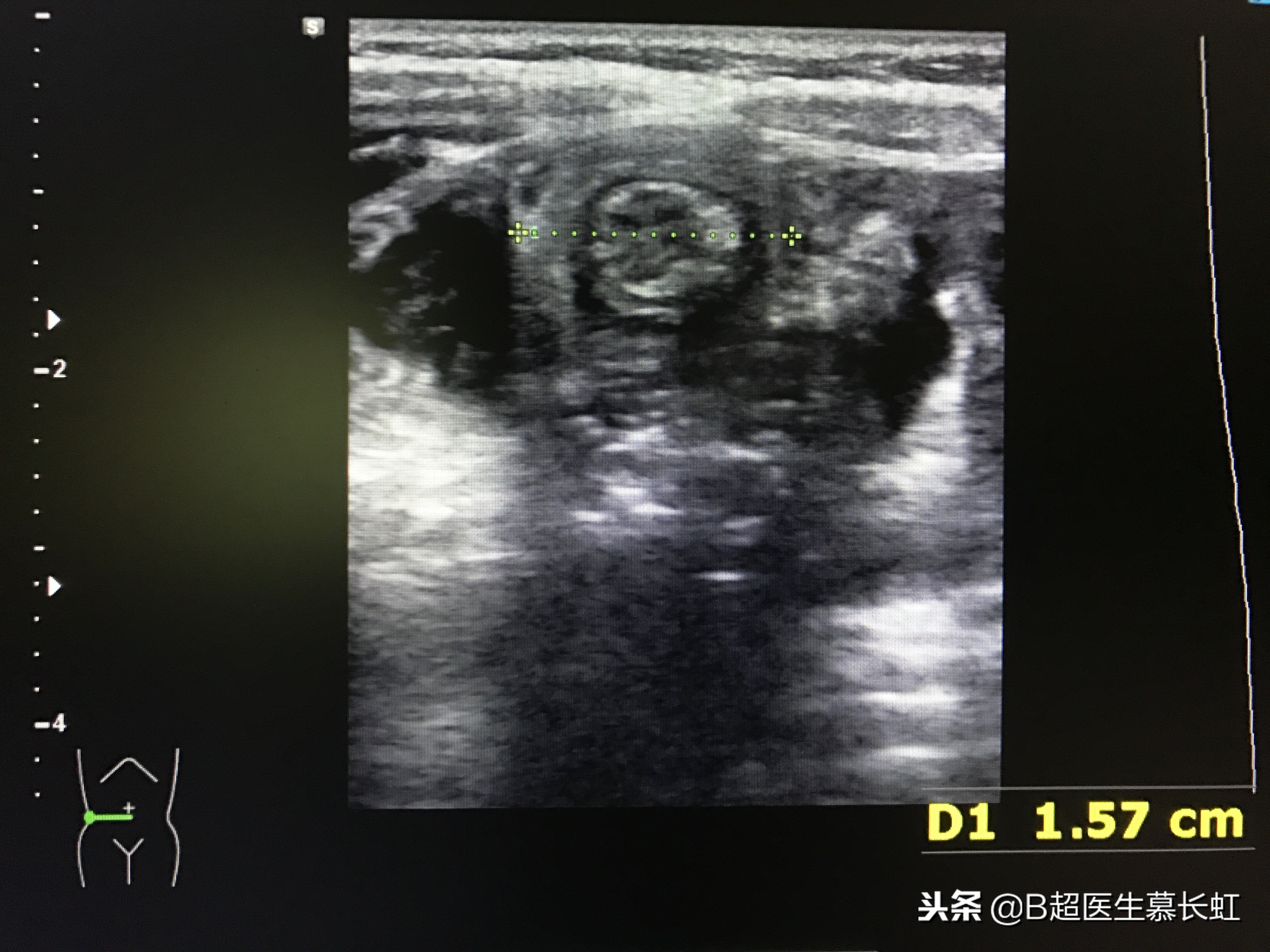 儿童肚子疼呕吐拉血怎么回事,2岁宝宝说肚子痛肠套叠