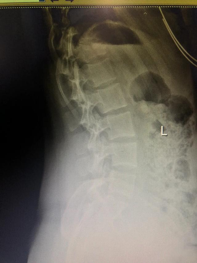 摔跤了坐起来腰部很疼是什么原因,摔跤腰扭伤阴天疼痛后遗症