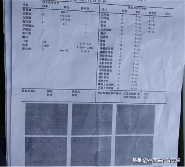 肾病综合征患者得肺癌怎么治疗,肾病综合征与肺癌患者