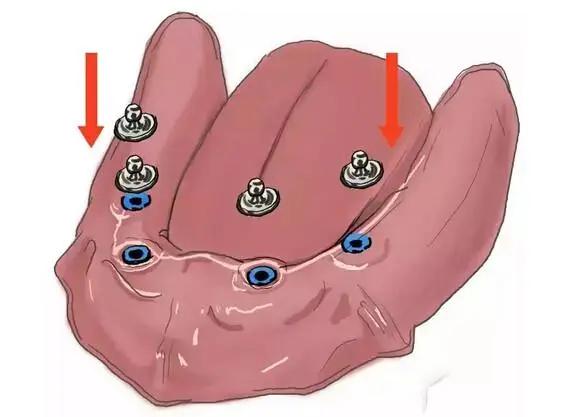 传统的种植牙和即刻种牙的区别,什么是种牙方法