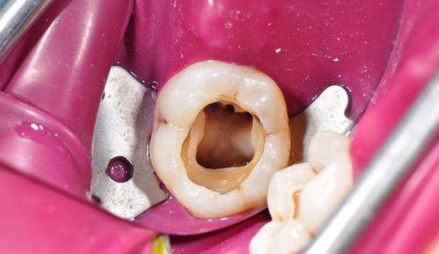 残根烂牙需要处理吗,牙残根还能保留吗