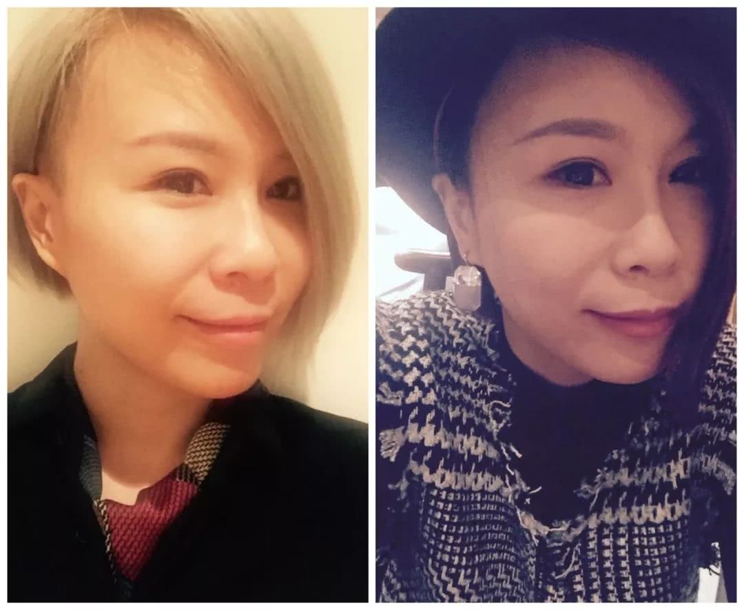 号称“1小时逆龄10年”的微整？我亲身体验了