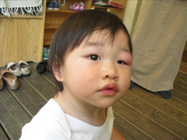 孩子被咬后，若显现这些状况代表不是蚊子咬的包，别自行处理