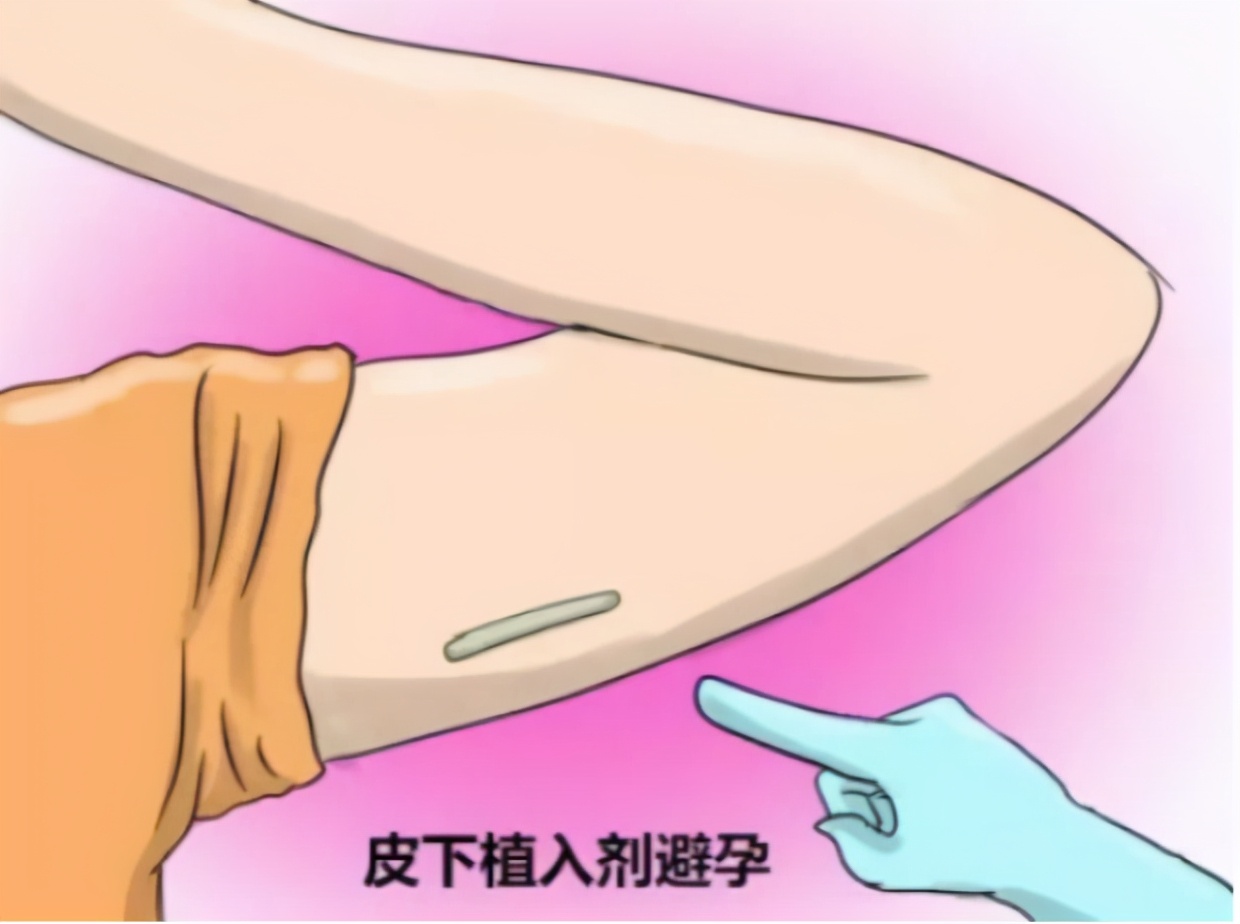 男女怎样避孕才不伤害身体,有效的避孕方法不伤身