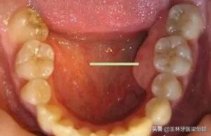 张口呼吸会导致牙槽骨突出吗,牙槽骨突起来了怎么办