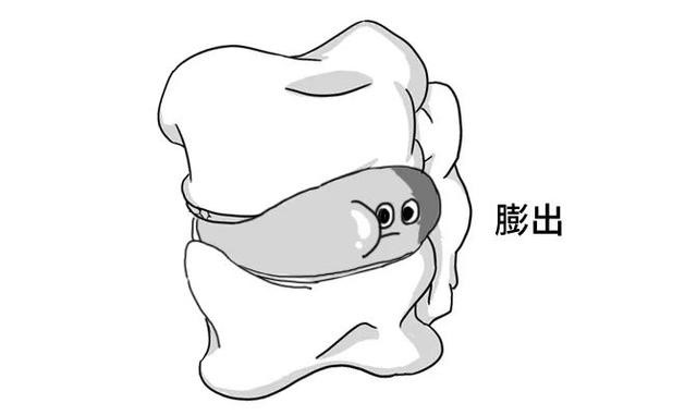 腰椎间盘轻度膨出症状有哪些,同样是腰椎膨出为啥有人无症状