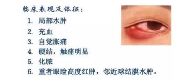 针眼用什么偏方去掉,民间治疗针眼神奇的方法