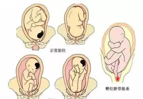 惊险孕妇在急救车上生下宝宝,孕妇遭遇车祸孩子奇迹生还