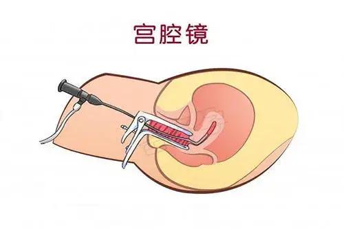 慢性子宫内膜炎的中医疗法,慢性子宫内膜炎的宫腔镜表现