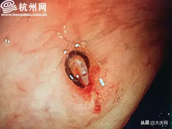 女子反复便血,女子反复便血竟查出肠癌