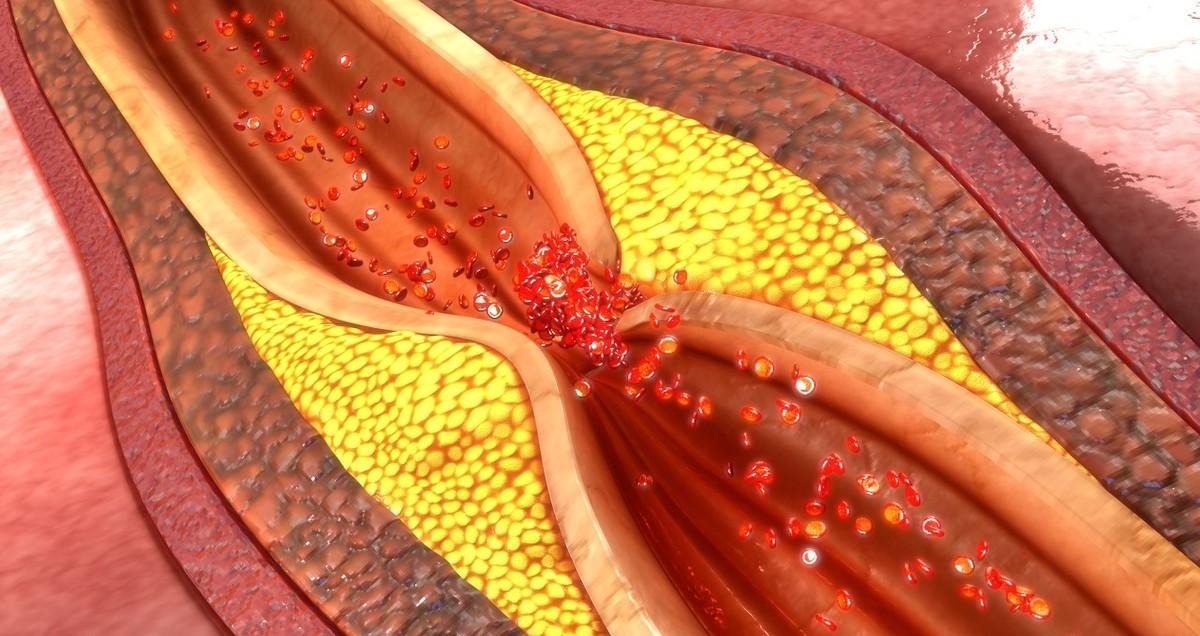 动脉粥样硬化斑块吃哪种他汀最好,他汀类药物针对动脉斑块有作用吗