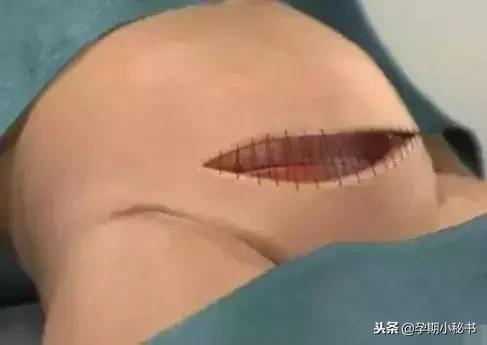 剖腹产最疼的是什么步骤,剖腹产手术步骤详解