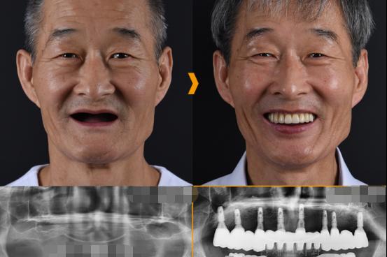 牙齿拥挤又缺失6号牙如何矫正,牙齿多颗缺失牙周炎严重怎么办
