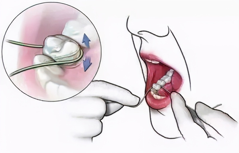 孕妇患上牙周病是什么原因,得了牙周病去哪里治疗