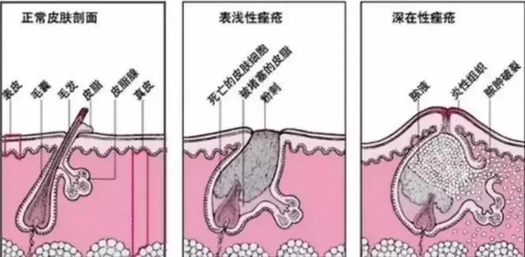 蜂胶消炎祛痘,蜂胶治疗皮癣吗