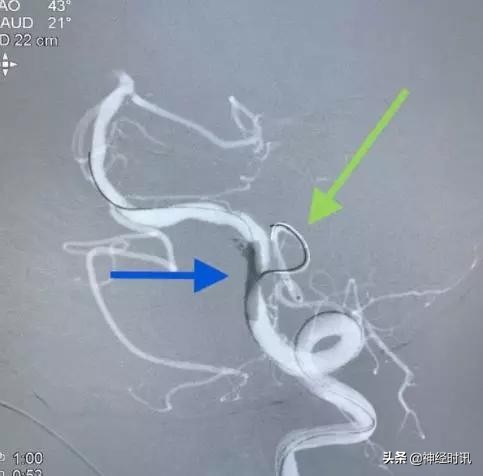 脑血管病介入治疗的介绍,缺血性脑血管病介入治疗进展2015