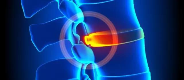 程序员腰椎间盘突出,程序员最怕的腰间盘突出