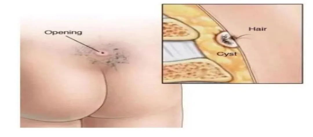 毛发逆生长小心藏毛窦,尾部藏毛窦治疗方法