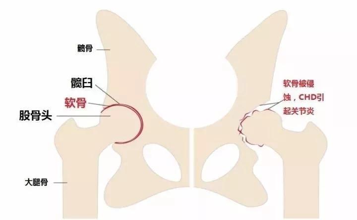 髋关节出了问题一个动作自测,这些症状你千万别再忽略了