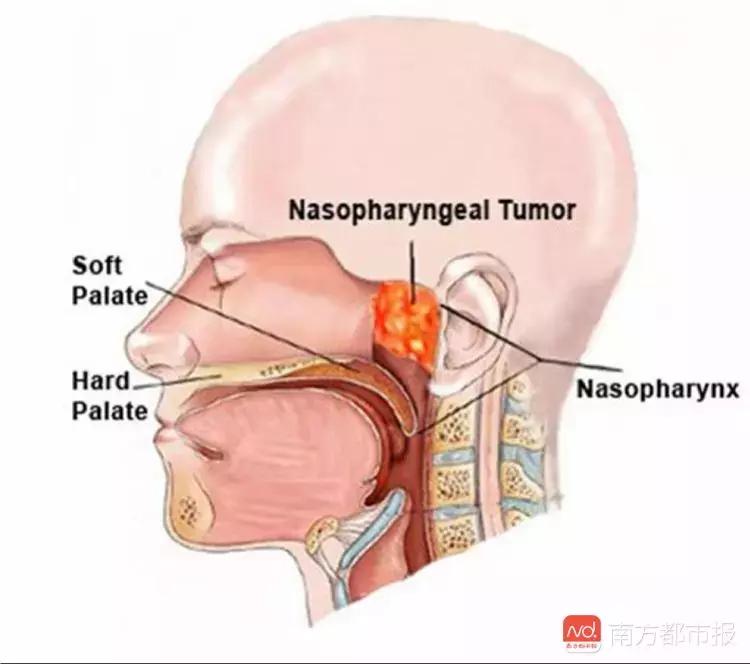 鼻咽癌放疗后该如何进行康复锻炼,鼻咽癌放疗后该如何护理