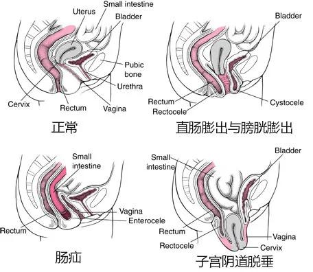 医生说尿尿多怎么办,笑到尿裤子该怎么治疗