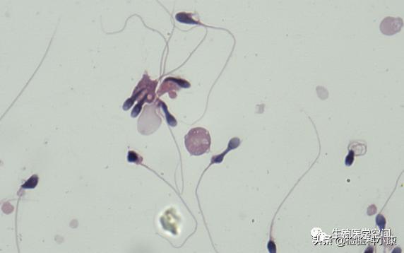 检查精子dna碎片报告怎么看,精子检查哪几项才知道是不是正常