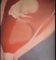 三分钟无痛人流的原理,三分钟无痛人流