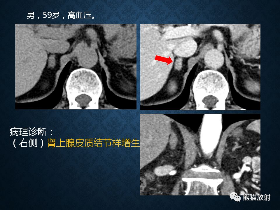 纵隔和肾上腺恶性肿瘤,纵隔性肿瘤位置图