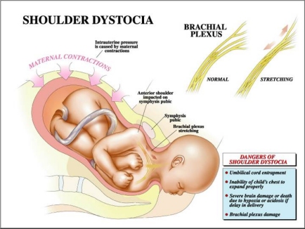新生儿锁骨骨折医院有没有责任,新生儿锁骨骨折属于医疗事故吗