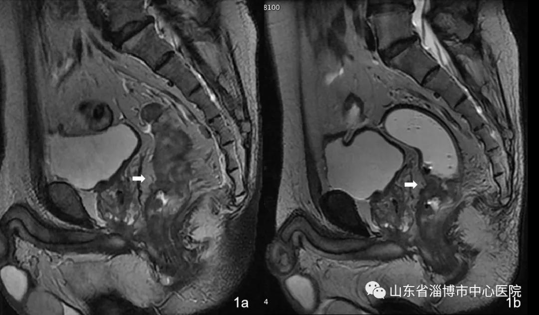 直肠指检不发现的病,直肠指检发现不了什么