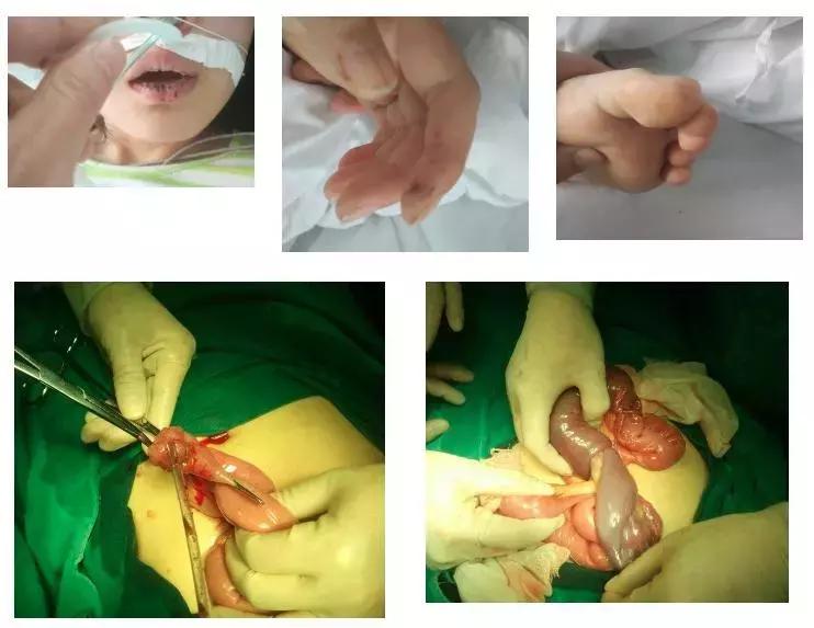 肠内有息肉脸上会长斑吗,有唇斑是肠道息肉吗