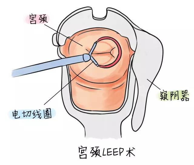 备孕期查出宫颈中度炎症怎么办,备孕期间宫颈糜烂怎么调理