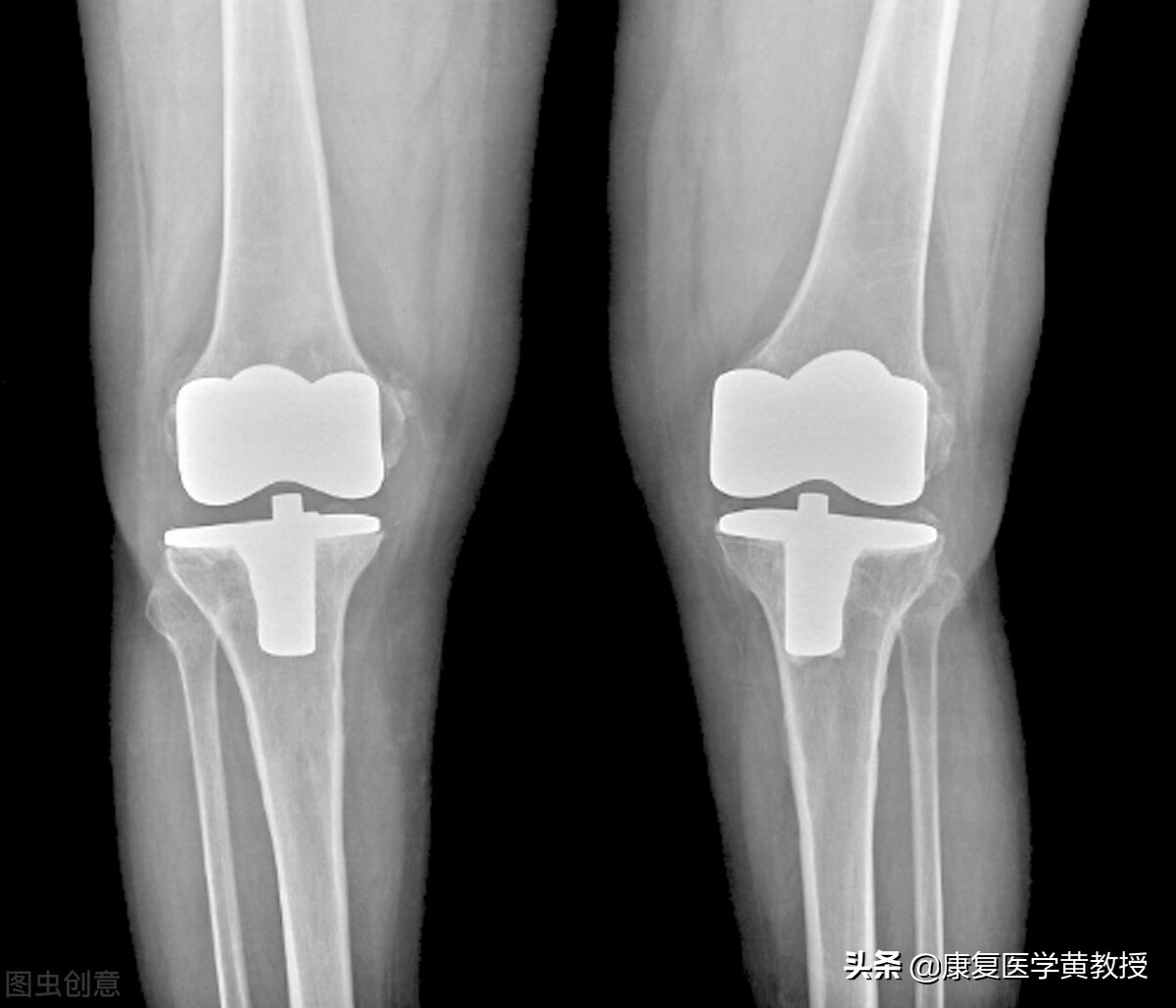 贴膏药为什麽能治疗疼痛，却治不了退行性关节炎？赶紧过来围观