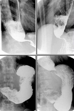 贲门失弛缓症不吃饭也噎得慌,酸导致的胸口痛是贲门没关上吗