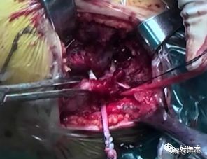 肩锁关节脱位手术后多久可以喝酒,肩锁关节脱位钢板内固定步骤记录