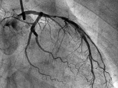 心脏血管狭窄ct造影结果准确吗,冠脉ct轻度狭窄还用做造影吗