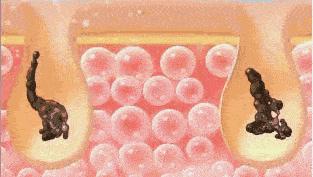 黑头反复怎么办一招教你去黑头,还在为黑头烦恼一招教你祛黑头