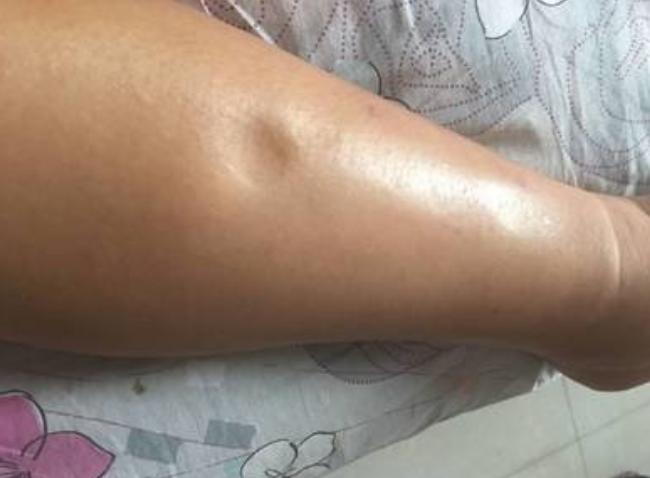 孕期脚肿是好还是不好,脚肿的和馒头一样大