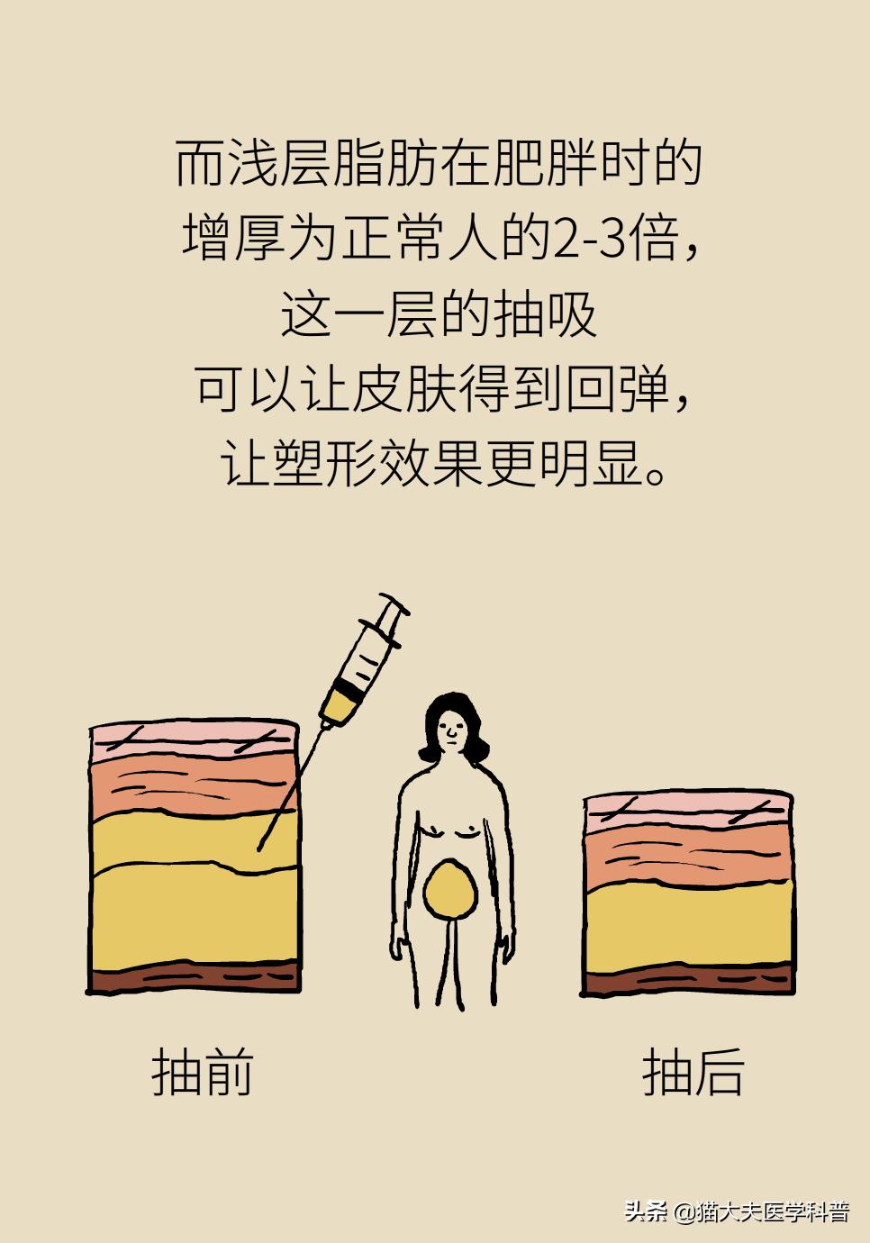 吸脂是怎么吸的,吸脂手术一次就可以吗