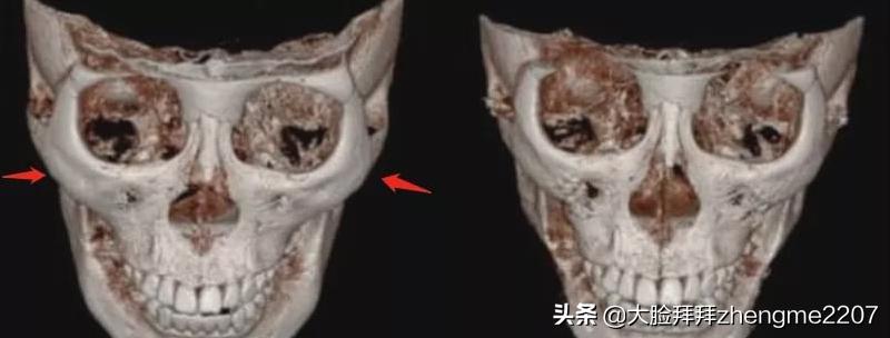 颧骨颧弓内推手术全过程真人,颧骨内推颧弓手术恢复全过程分享