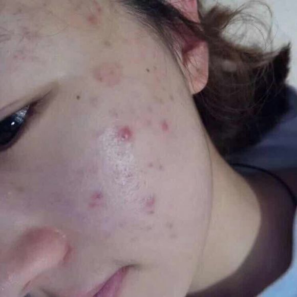 青春痘的护理方法及关注事项,如何预防和治疗青春痘最有效