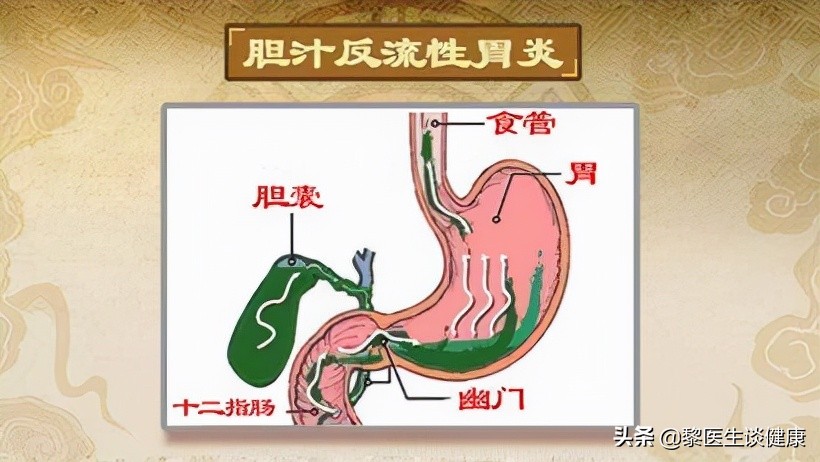 胆汁反流性胃炎胃镜多久做一次,做了胃镜有胆汁反流是胆囊发炎吗