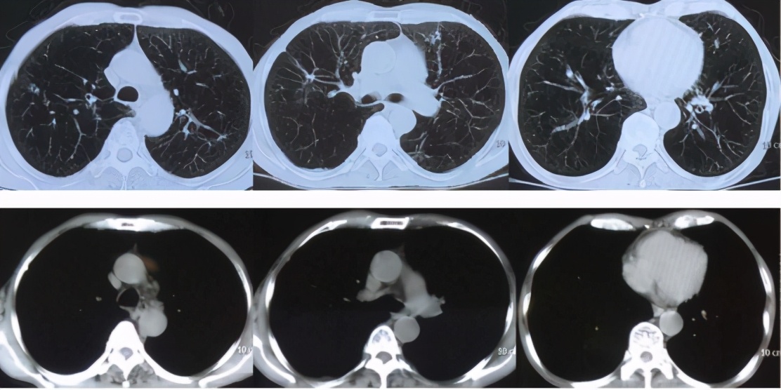 慢阻肺伴有急性加重能活几年,慢阻肺为什么会流鼻水