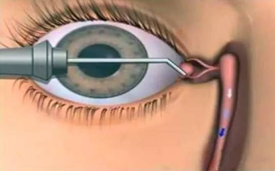 为什么我的眼里常含泪水？因为泪道病对我“爱”得深沉